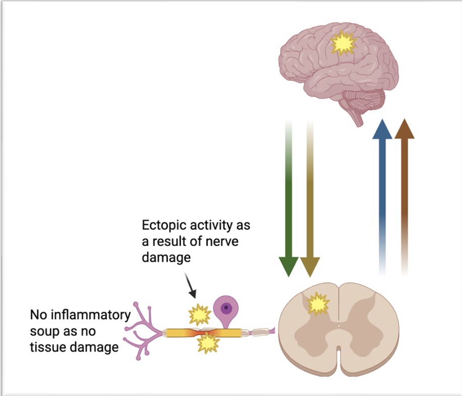 Diagram of neuropathic pain physiology