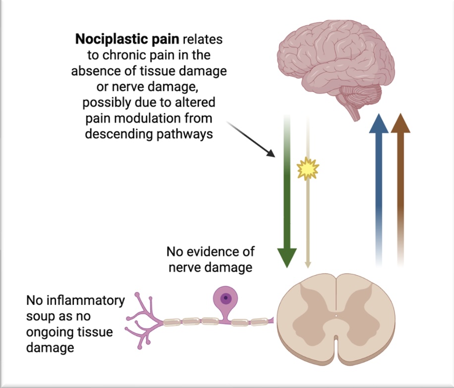 Diagram of physiology of nociplastic pain